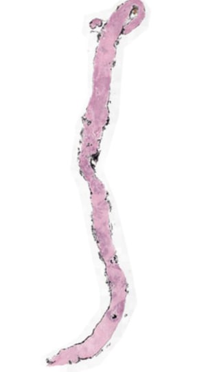 Fig 2: Shows Whole slide image of Tissue obtained through Biopsy for Diagnosis of concerned ailment.