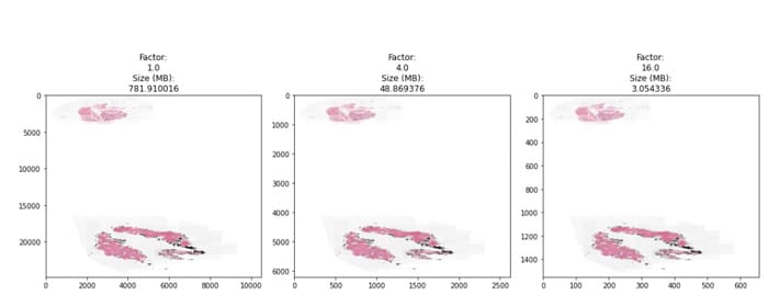 Fig 3: WSI of the Biopsy tissue